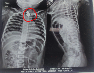 Doctors at Vidisha Medical College successfully remove metal pendant from baby’s throat via emergency endoscopic surgery