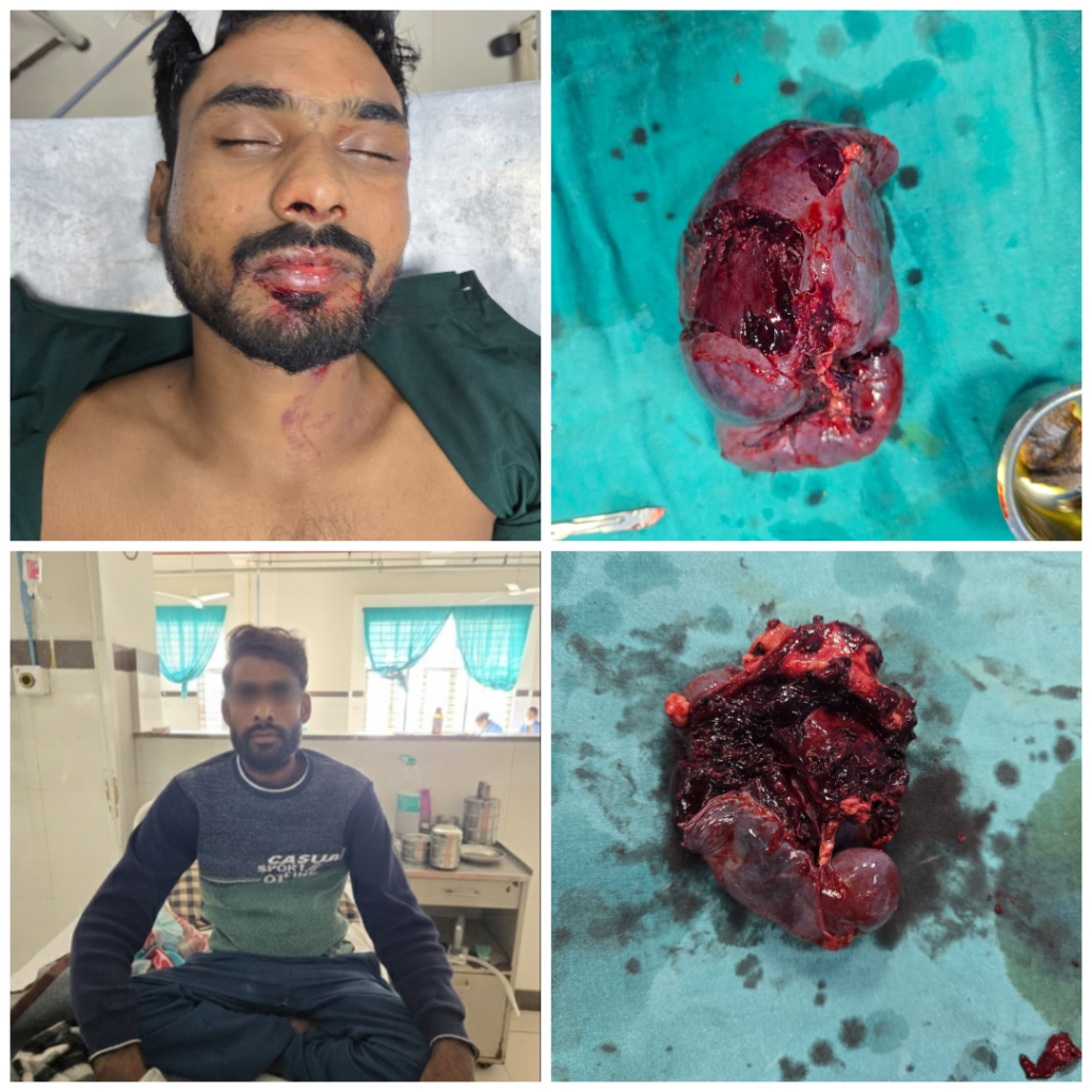Doctors performing critical splenic trauma surgery at Vidisha Medical College saving three lives