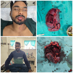 Doctors performing critical splenic trauma surgery at Vidisha Medical College saving three lives